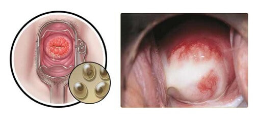 Chảy mủ bao quy đầu do bệnh Chlamydia